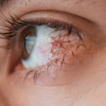 Ojo irritado conjuntivitis alérgica