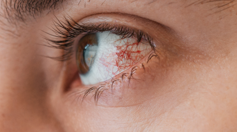 Ojo irritado conjuntivitis alérgica