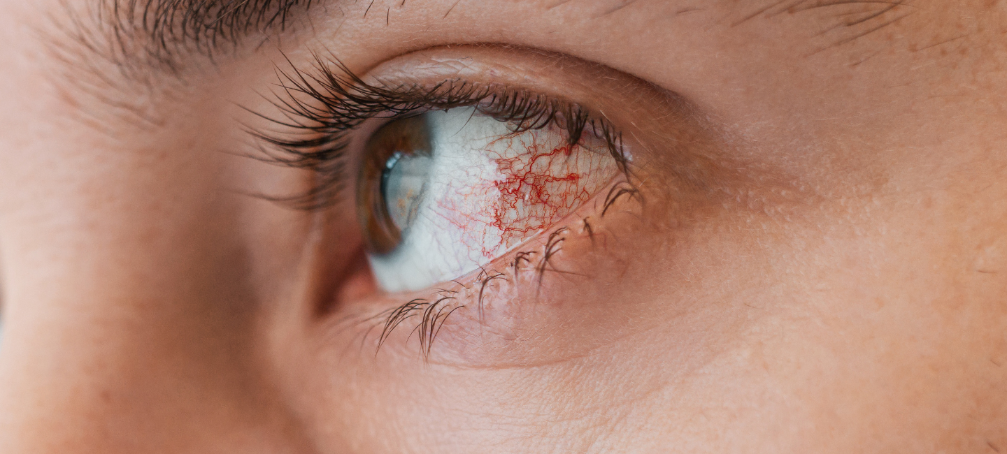 Ojo irritado conjuntivitis alérgica