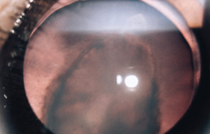 lenticono posterior, afección ocular, fotografía clínica