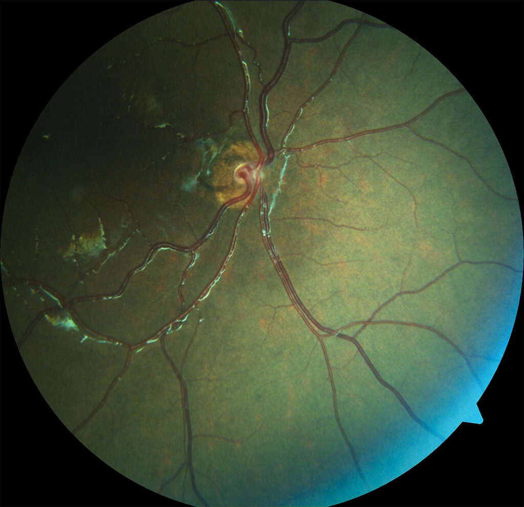 Hipoplasia/ Agenesia de nervio óptico. Fotografía clínica