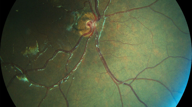 Hipoplasia/ Agenesia de nervio óptico. Fotografía clínica