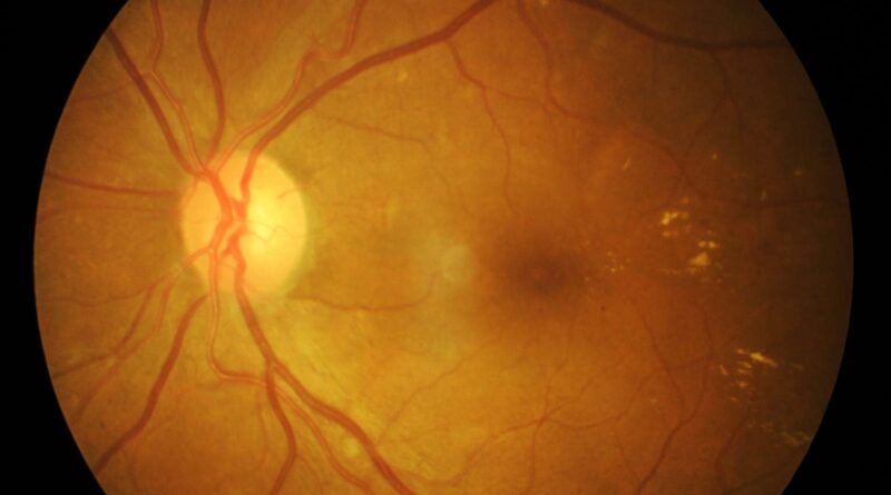 Desprendimiento de retina corregida con retinectomía