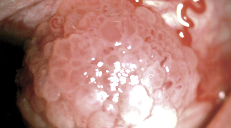 Lesión en superficie ocular clínica en paciente femenino