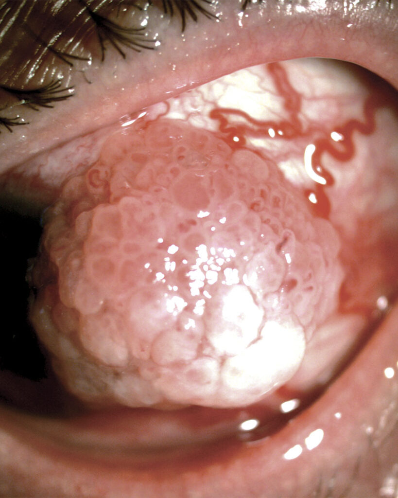 Lesión en superficie ocular clínica en paciente femenino