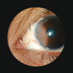 Fotografía de ojo con neoplasia escamosa de superficie ocular visto de cerca
