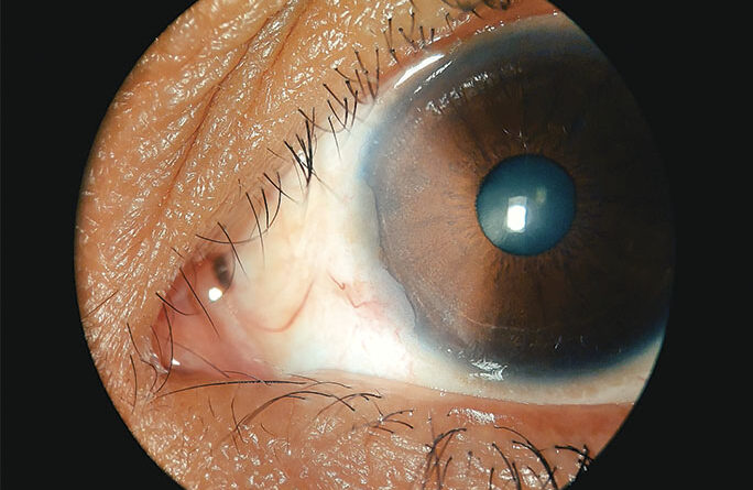 Fotografía de ojo con neoplasia escamosa de superficie ocular visto de cerca