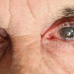 adulto mayor con enfermedad en los ojos glaucoma o cataratas