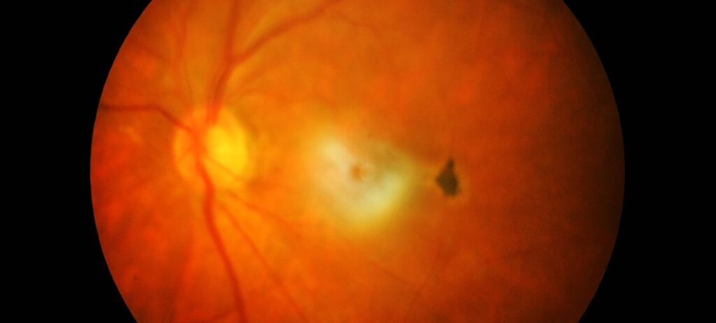 acercamiento de un globo ocular durante estudio de retina donde se observan algunas venas