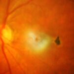 acercamiento de un globo ocular durante estudio de retina donde se observan algunas venas