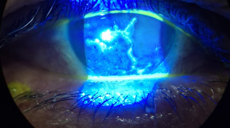 enfermedad clínica, fotografía de herpes ocular para su estudio