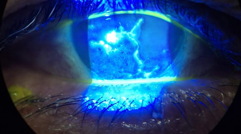 enfermedad clínica, fotografía de herpes ocular para su estudio