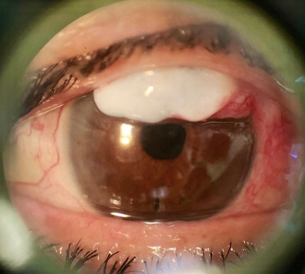 Ampolla en ojo mostrada en fotografía clínica para estudio de enfermedades oculares, enfocado en tratamiento de trabeculoplastia láser selectiva (SLT)