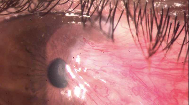 Imagen clínica que muestra el pterigión o carnosidad ocular avanzando desde el lagrimal hacia la córnea, con tejido rojo e inflamado.