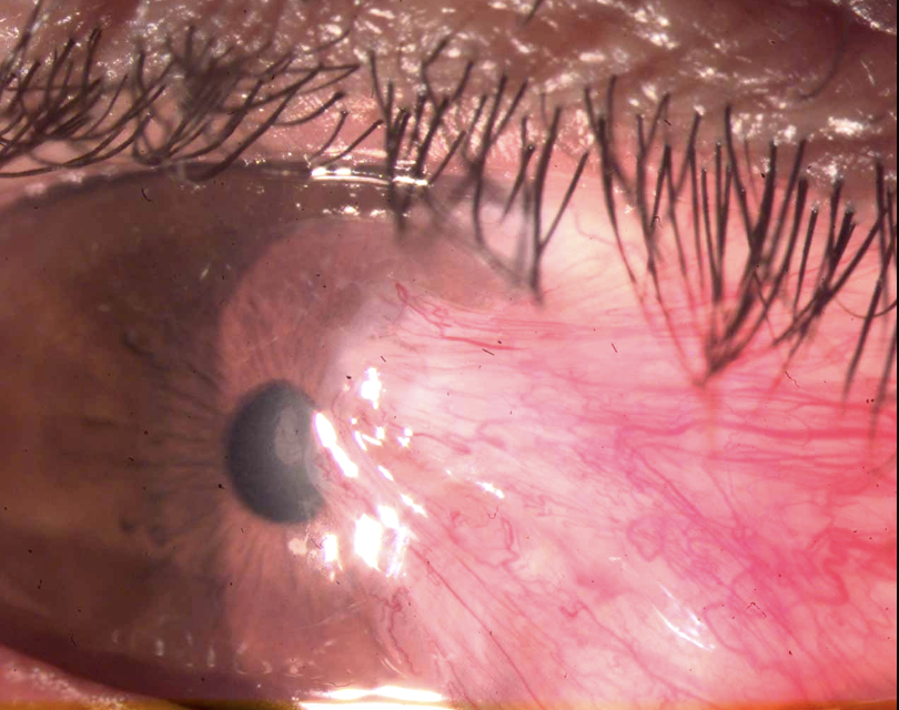 Imagen clínica que muestra el pterigión o carnosidad ocular avanzando desde el lagrimal hacia la córnea, con tejido rojo e inflamado.