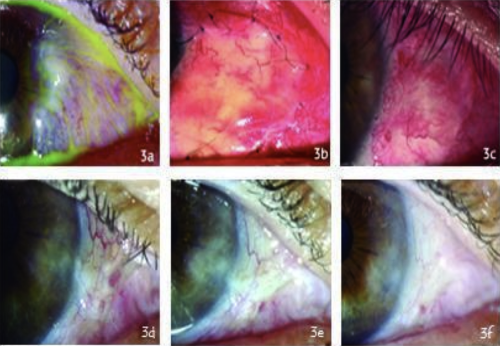 Serie de imágenes del ojo de un paciente antes y después de una cirugía de pterigión. Se observa el proceso de cicatrización y recuperación a los seis meses del procedimiento.