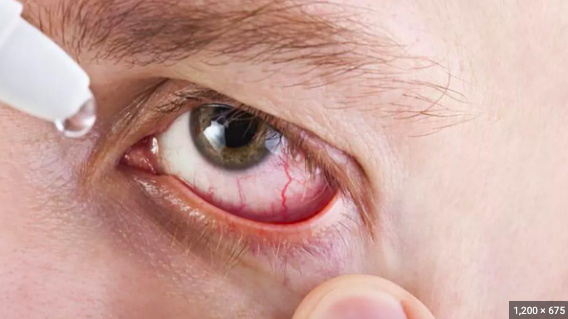 Se observa en primer plano el ojo irritado de un hombre, mientras éste aplica gotas para ojo seco, en el contexto de un estudio sobre célula caliciforme y ojo seco