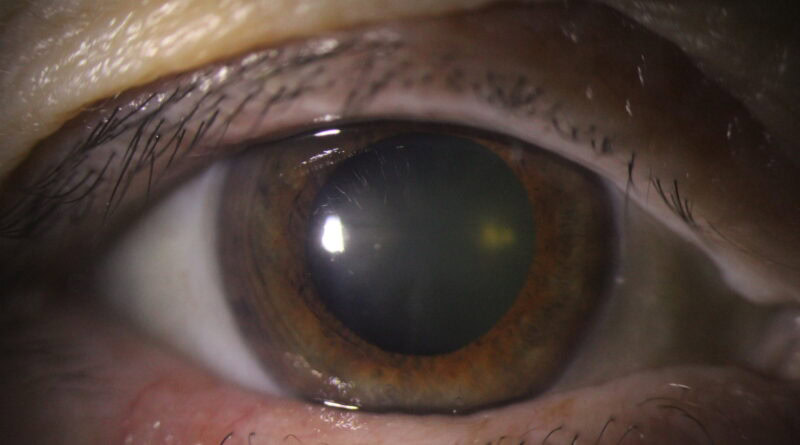 Imagen clínica de un ojo humano con catarata avanzada, utilizada en el contexto del artículo sobre el tratamiento combinado de una semana con levofloxacino y dexametasona previo a cirugía de cataratas. Ilustra la opacidad del cristalino y apoya la comprensión visual del enfoque terapéutico innovador propuesto.