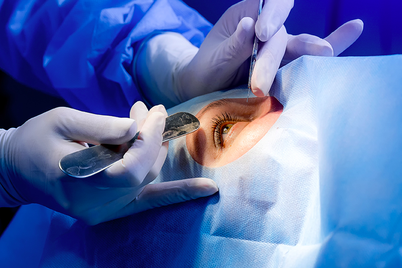 Imagen donde se realiza cirugía de glaucoma a persona adulta.