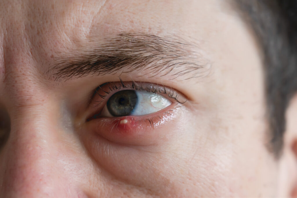 Hombre con una infección en la parte inferior del ojo