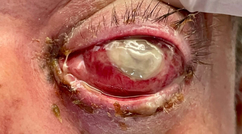 imagen cruda de endoftalmitis