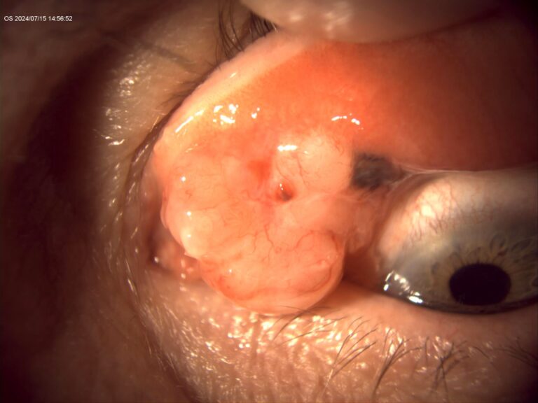 melanoma de conjuntiva