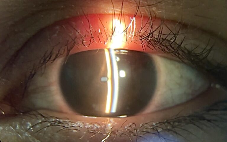 Microcoria o miosis congénita