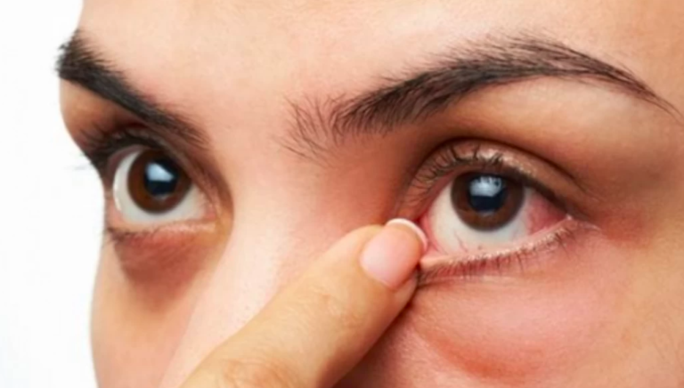 Ojo seco Visión global