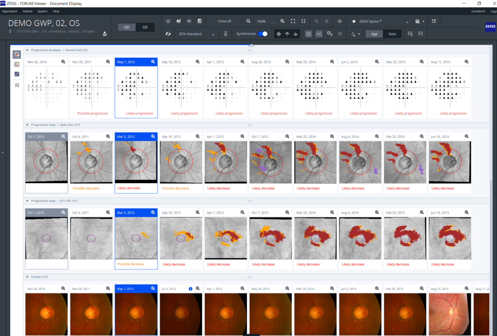 Análisis de glaucoma