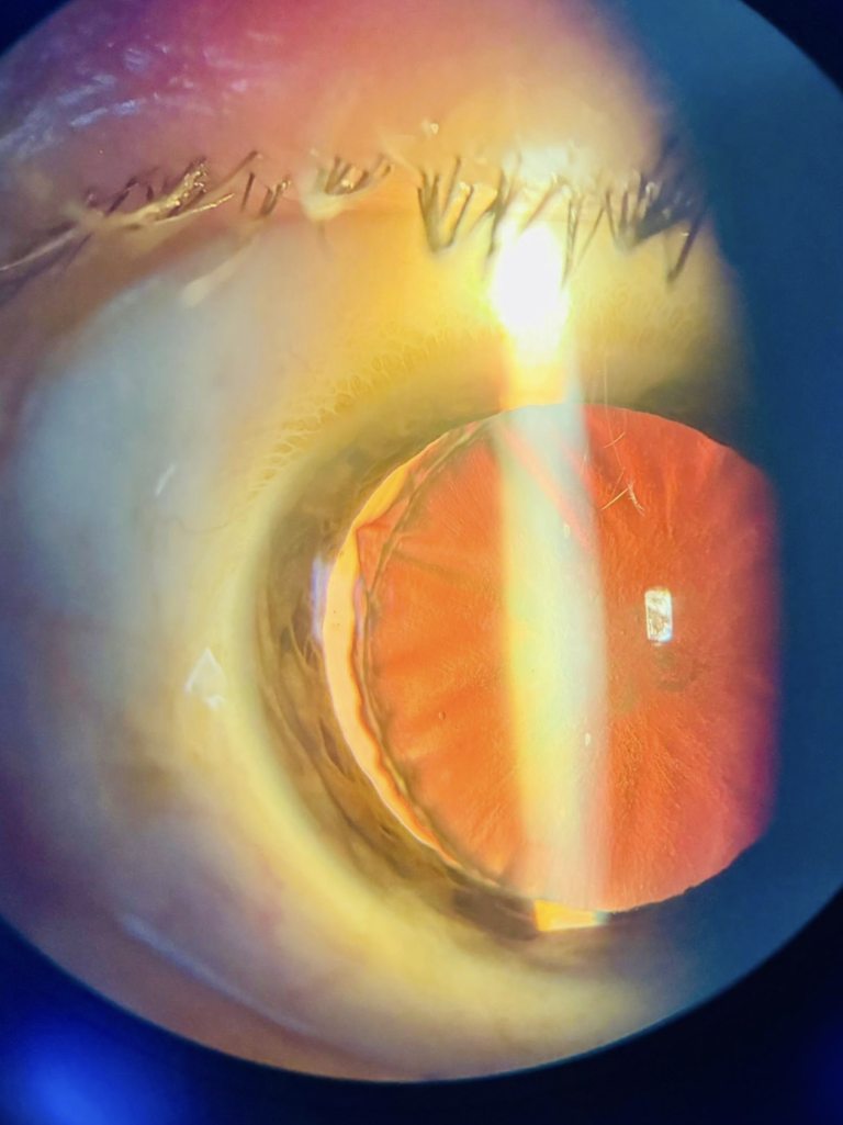 Fotografía clinica del mes_Vol.10_Catarata traumatica subluxada