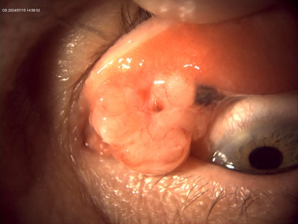 Fotografía clínica del mes_Vol.8_Melanoma de conjuntiva