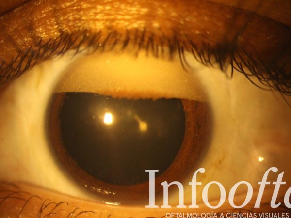 Reverse pseudohipopión pediátrico por silicón intraocular emulsificado